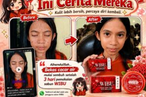 Bekas Cacar Air Mulai Memudar? Simak Pengalaman Pengguna Sabun WIBU Setelah Pemakaian Rutin