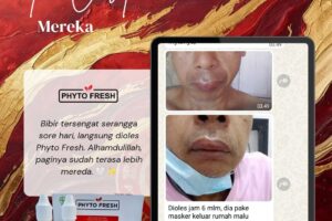 rasa nyeri dan bengkaknya terasa lebih mereda
